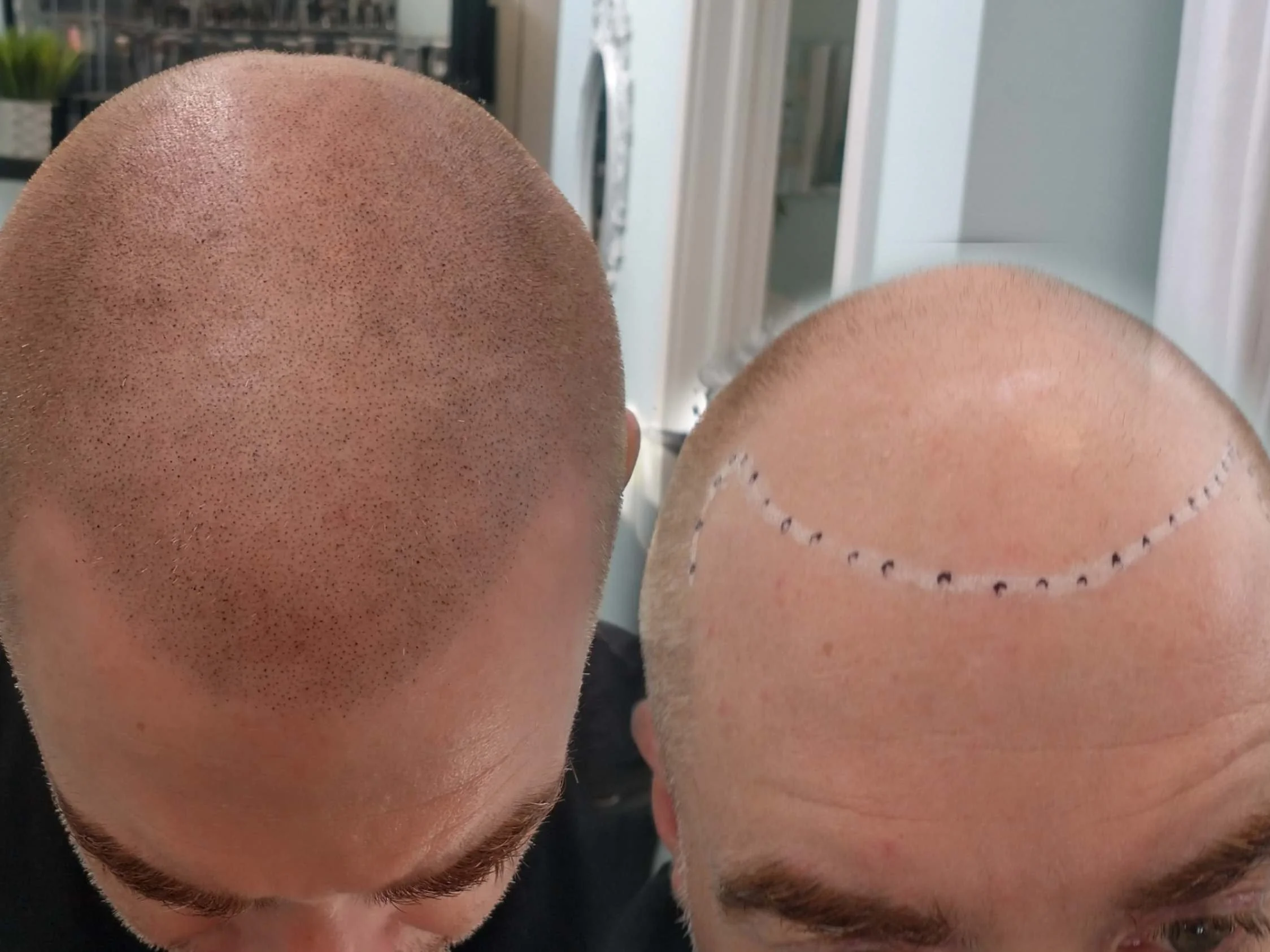 Another happy client after Scalp Micropigmentation