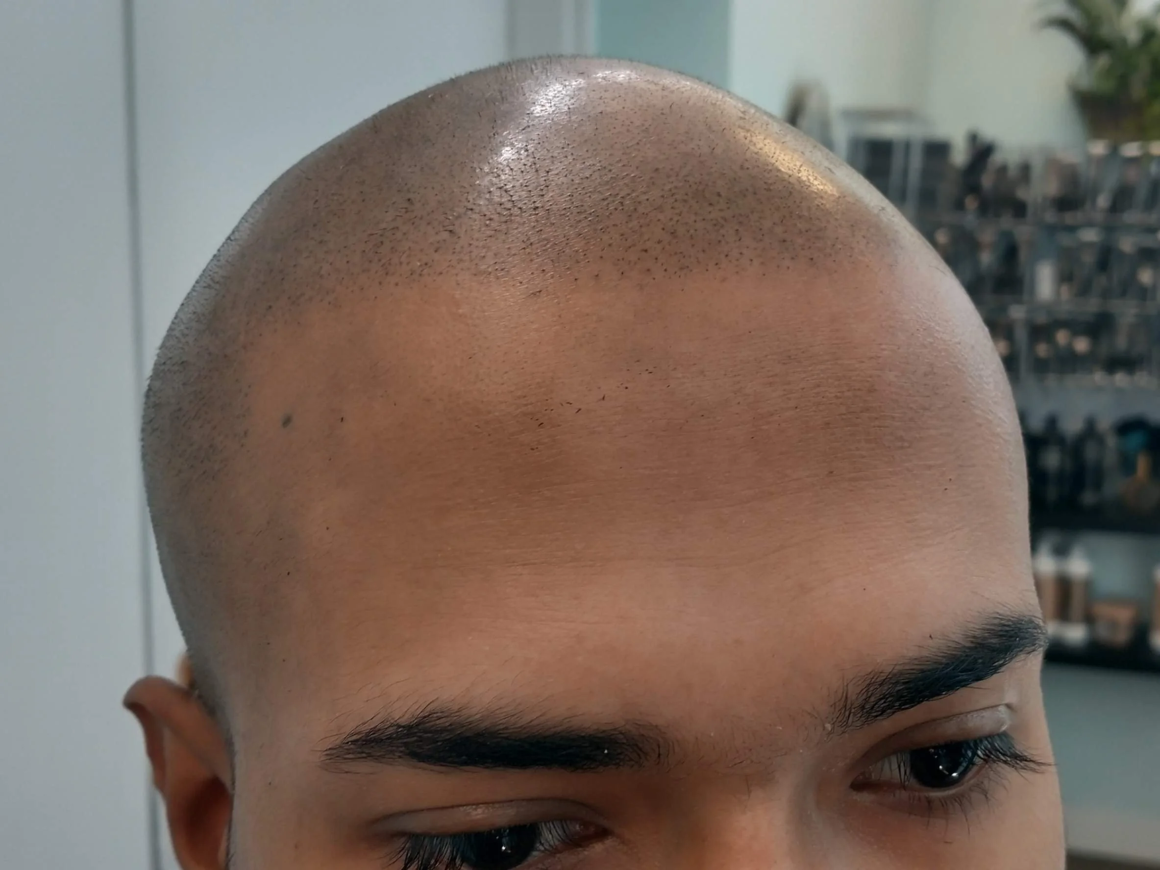 After session 4 scalp micropigmentation