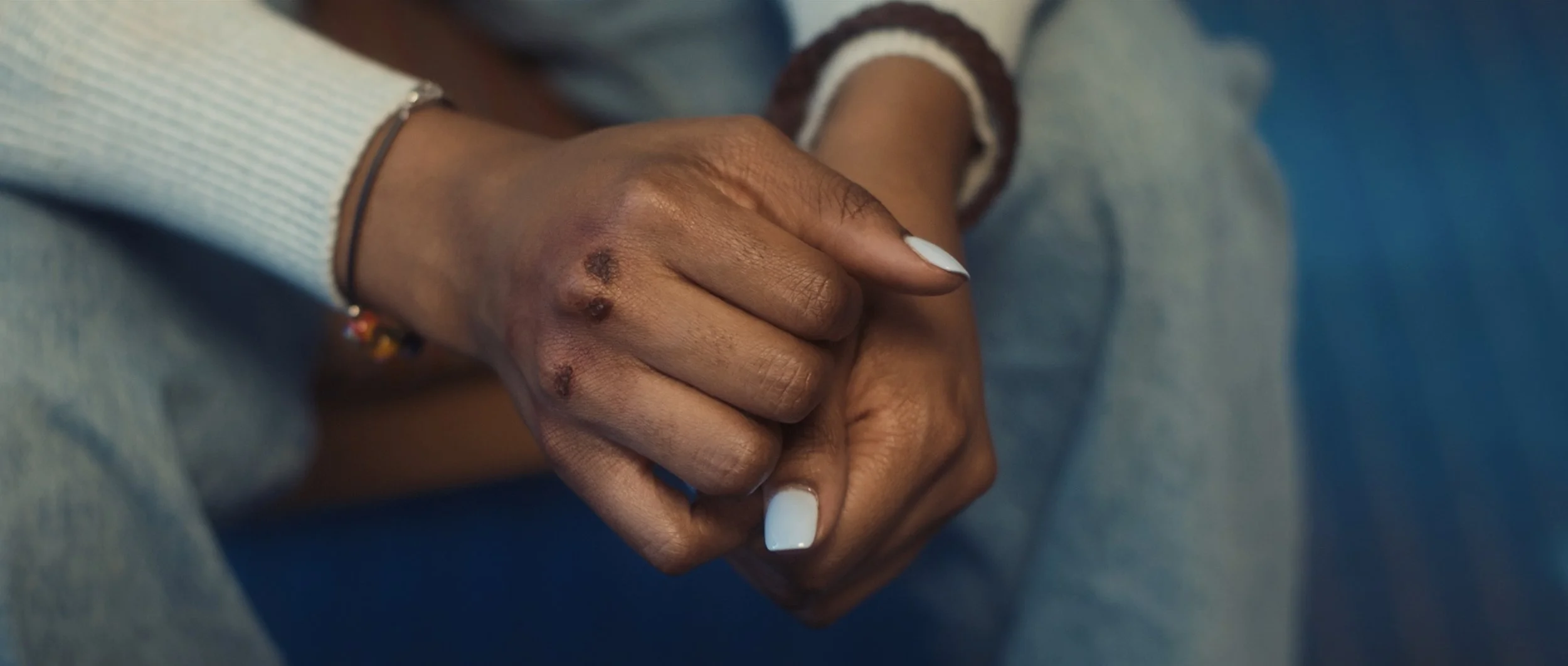 hand bruises anger management circle.jpg