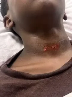 Apollo Beach Mother Demands Answers After 8-Year-Old Returns Home With Neck Injury on School Playground