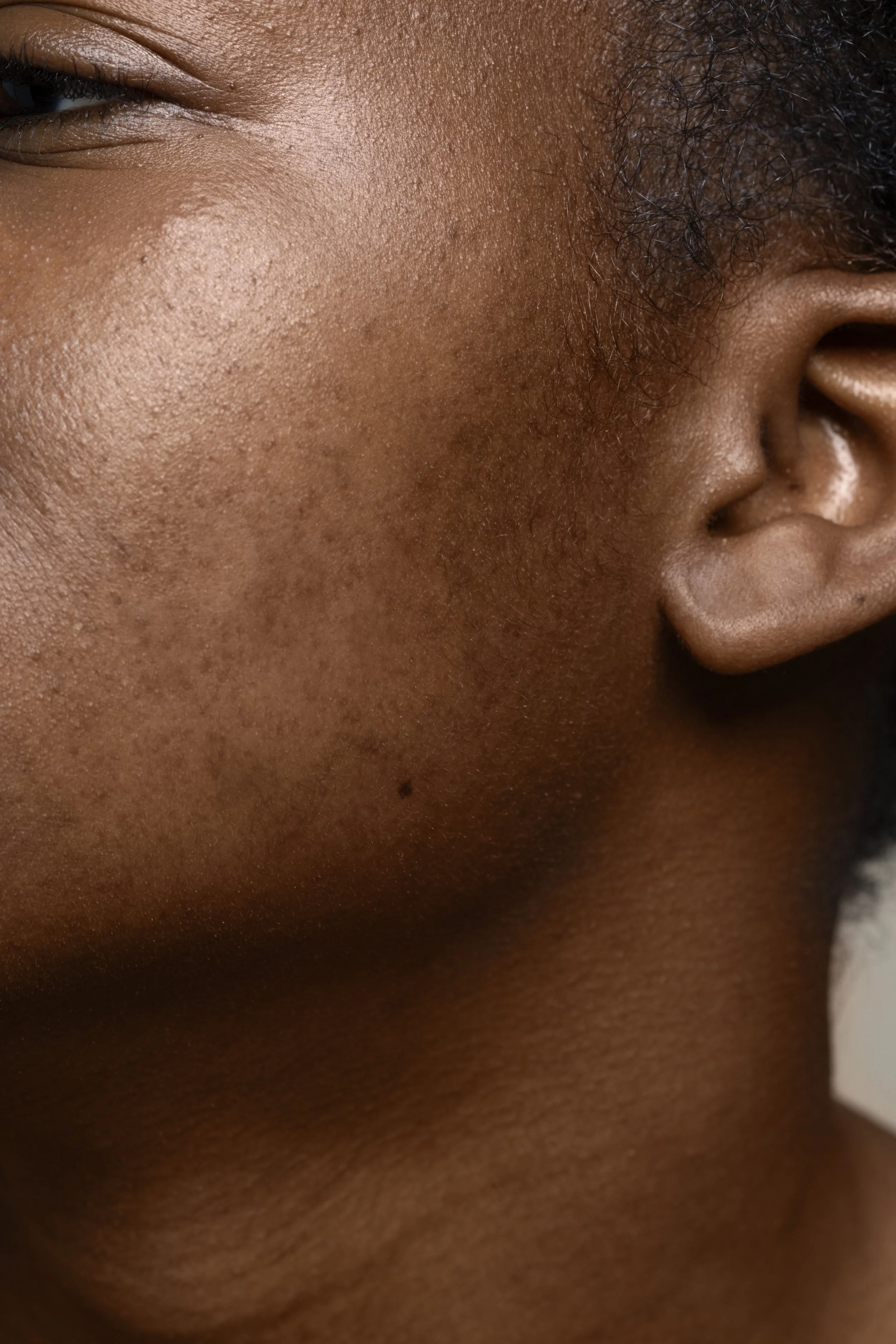 Different Types of Pigmentation: what’s causing your dark spots?