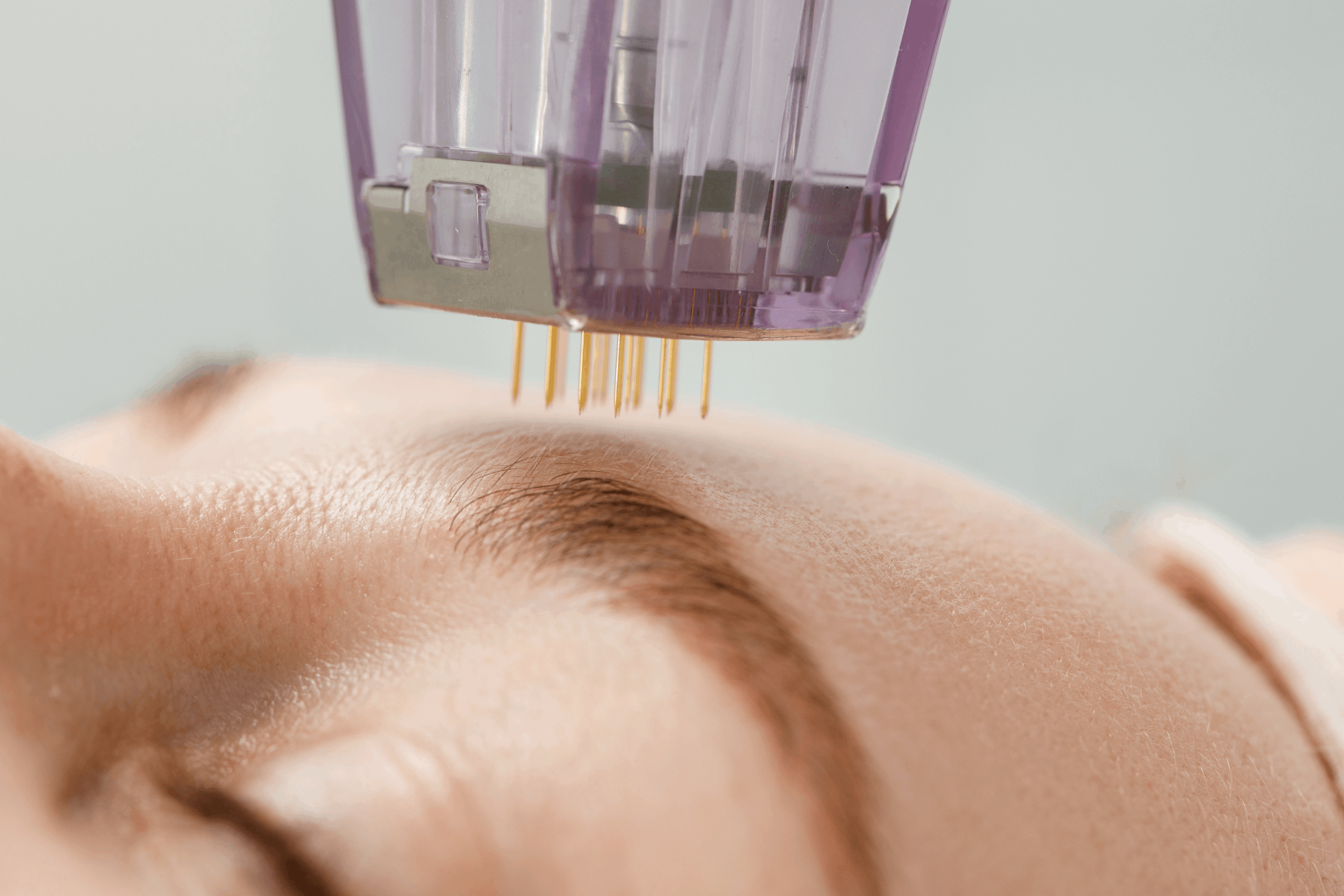 Unveiling the Magic of Microneedling: A Comprehensive Guide for Beginners