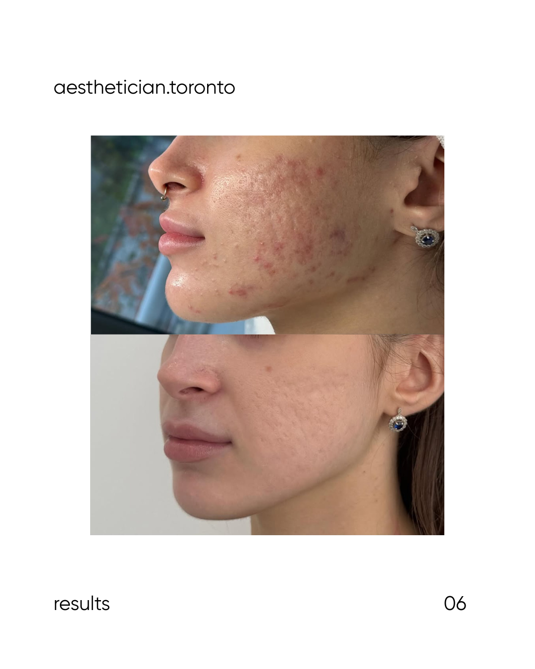 Side-by-side comparison of a woman's face showing acne and redness in the top image, and clear skin in the bottom image.