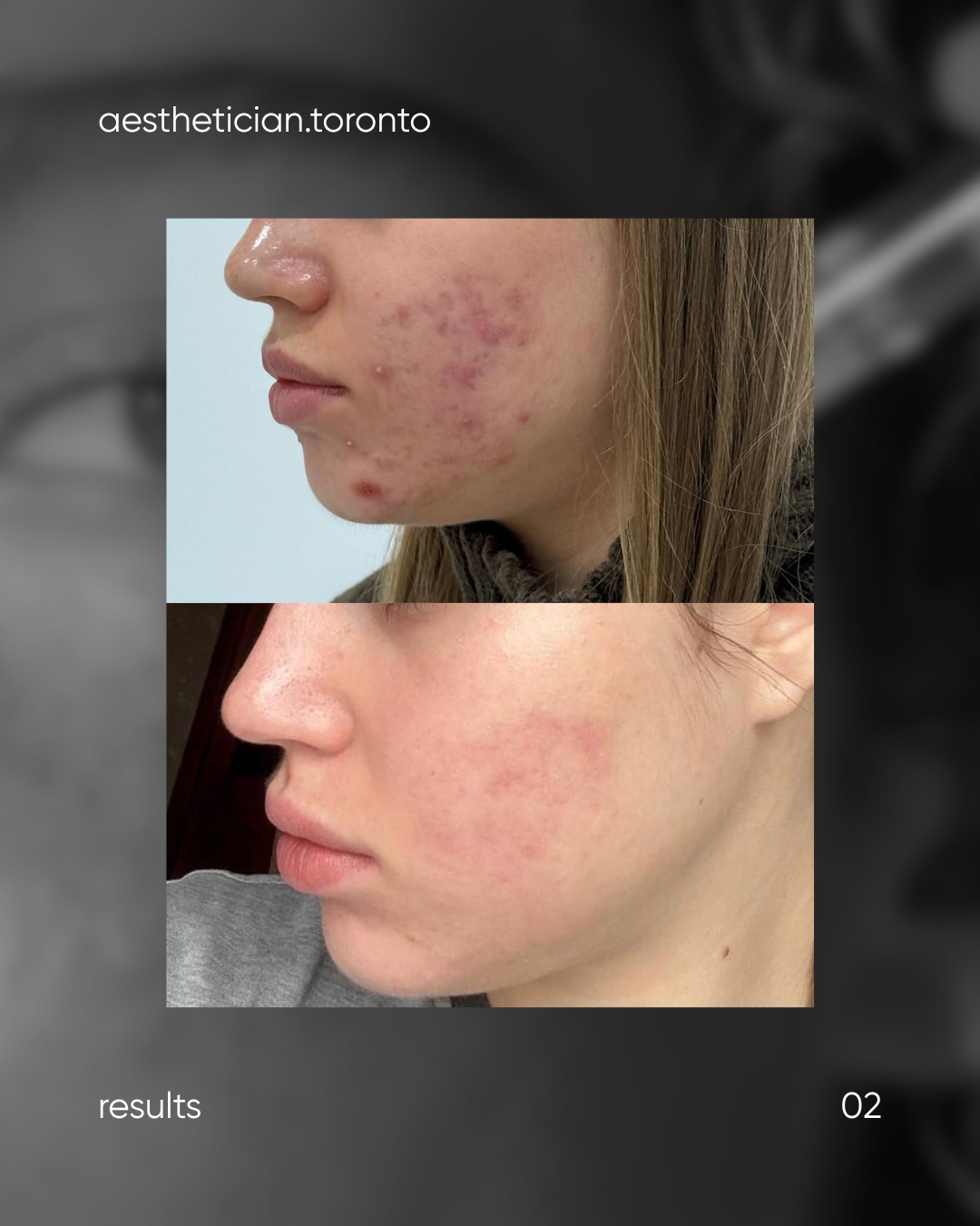 Before and after images of a woman's face showing improvement in acne and skin redness.