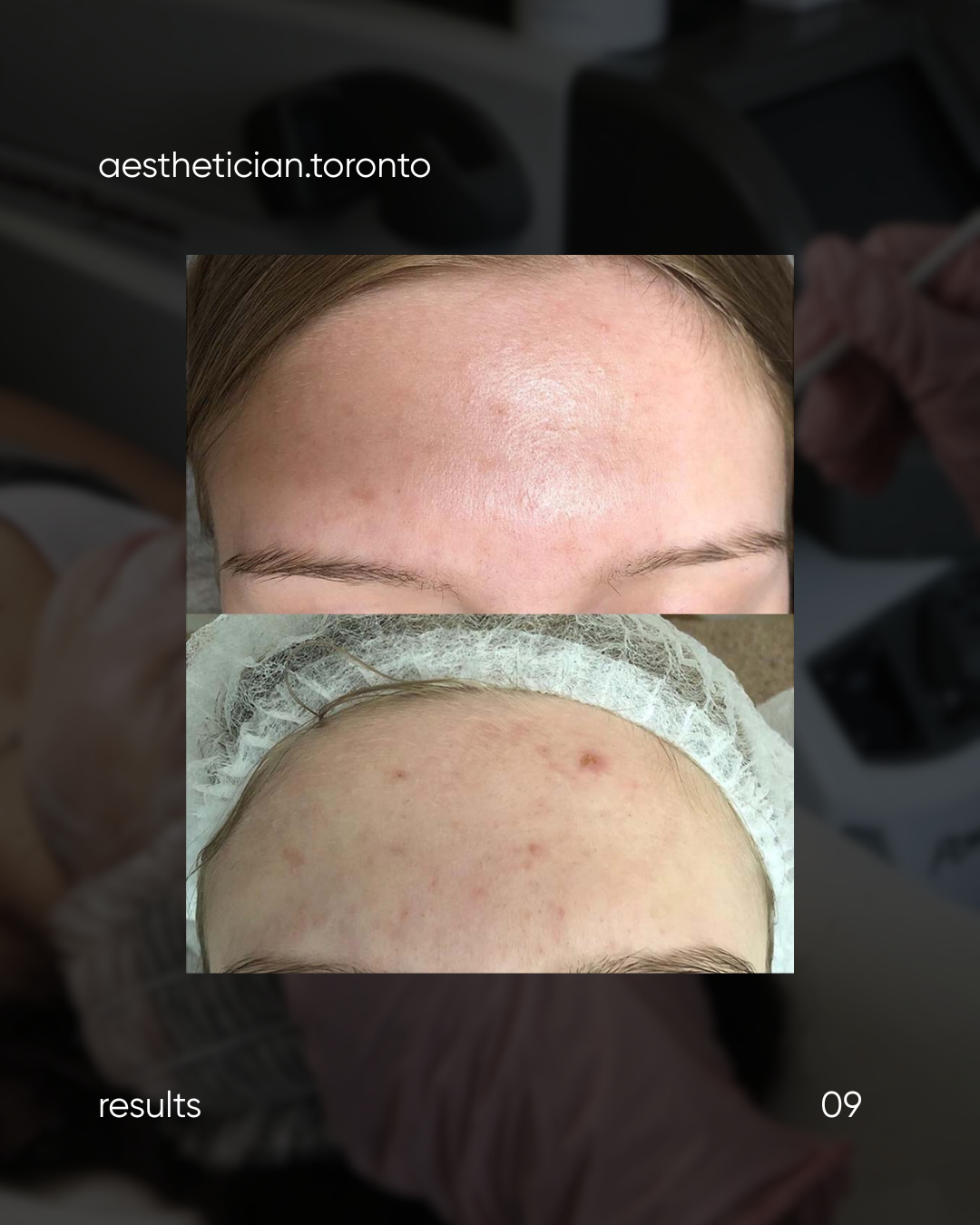 Comparison of before and after skincare or cosmetic treatment showing forehead skin improvement, top image with smoother skin, bottom image with acne and blemishes.