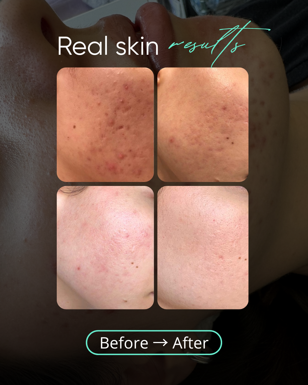 Close-up of facial skin showing improvement in acne and scarring, with before and after comparison photos.