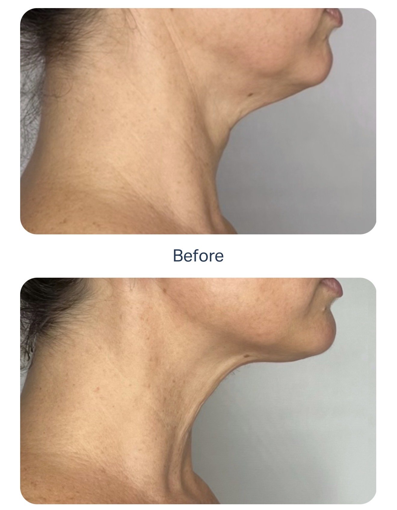 Comparison of a person's neck and jawline before and after a cosmetic procedure. The 'before' image shows a less defined jawline, while the 'after' image shows a more contoured and tightened jawline and neck area.