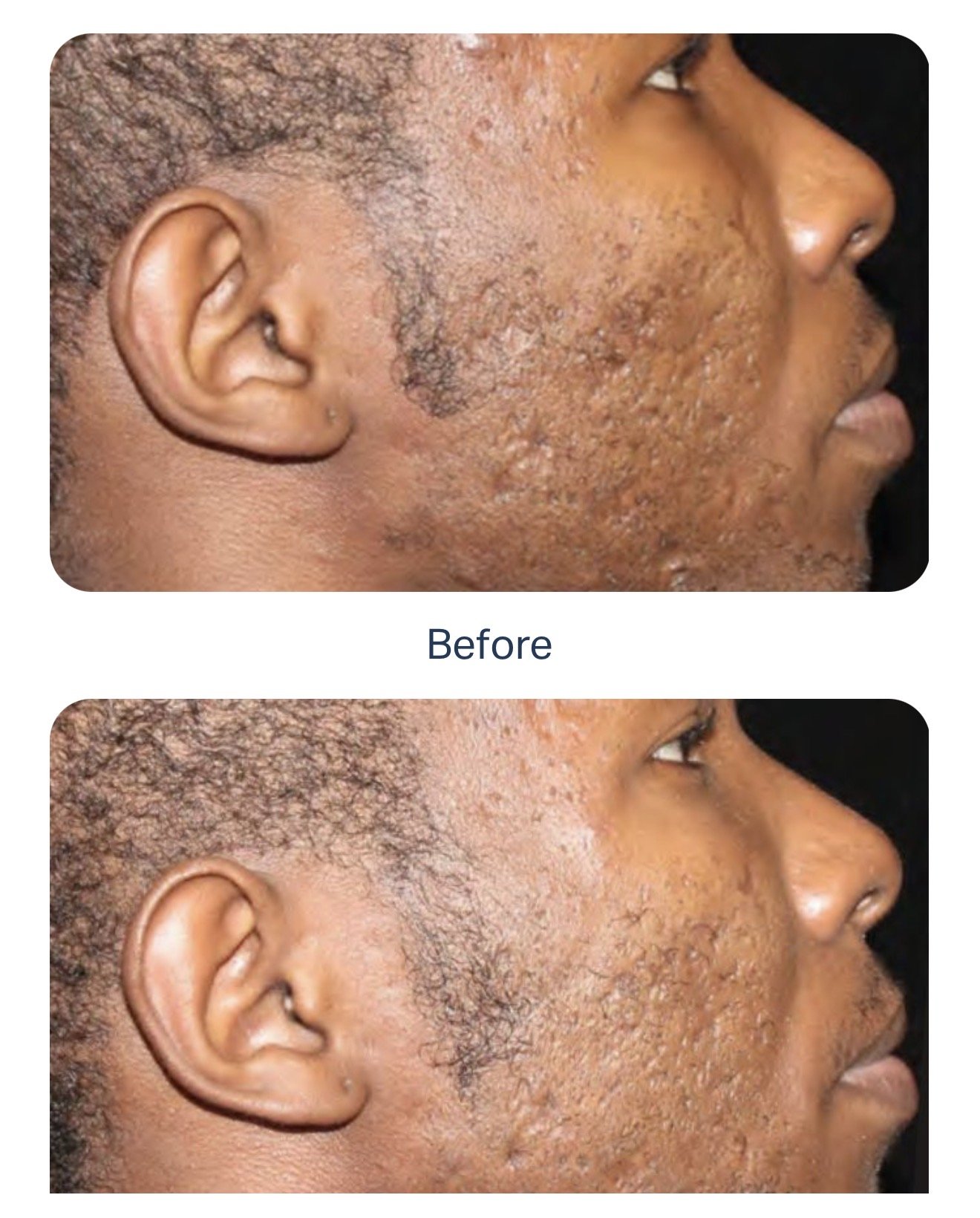 Side-by-side comparison of a person's face showing skin before and after treatment, with visible improvements in skin texture and appearance.
