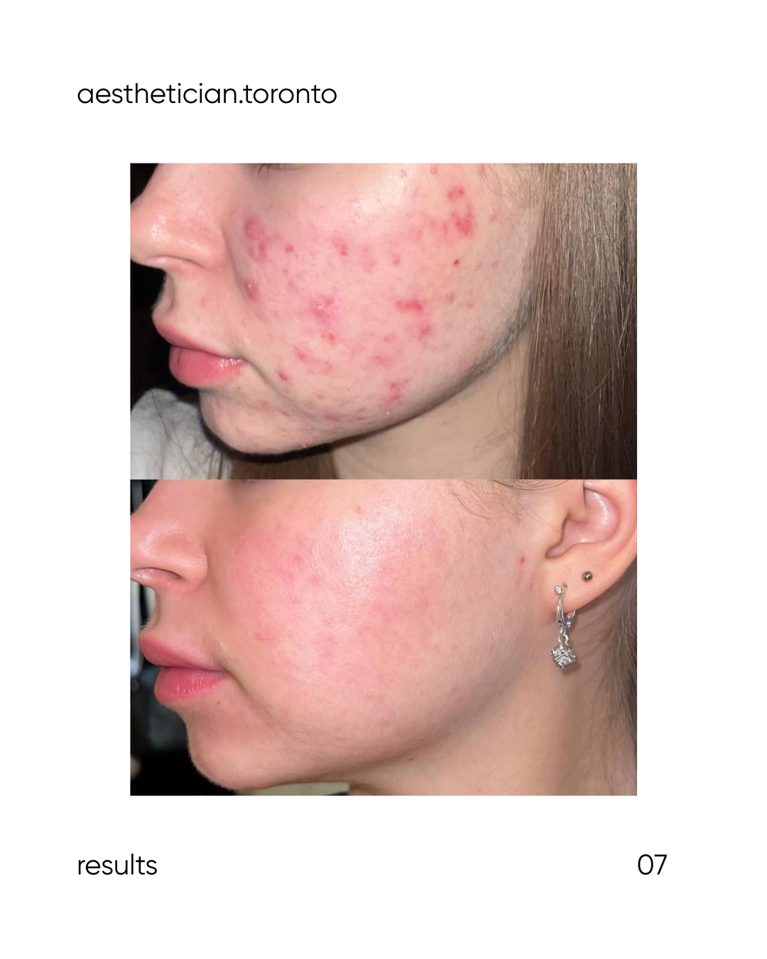 Before and after images showing a woman's face with acne; the first image depicts significant acne and skin blemishes, while the second image shows clear, acne-free skin with improved texture.