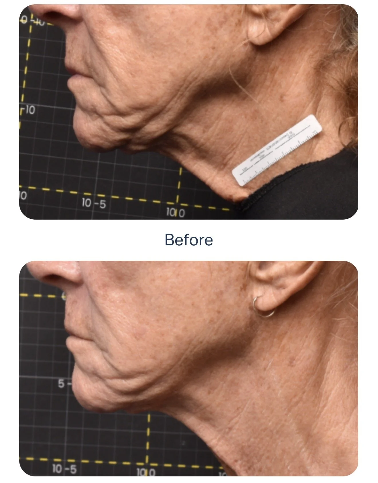Comparison of a person's neck and jaw area before and after a cosmetic or medical treatment, showing reduction in skin sagging and wrinkles.
