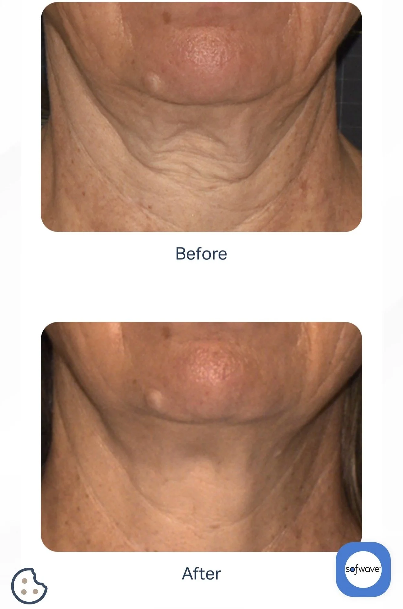 Side-by-side comparison of a person's neck skin before and after treatment, showing reduced wrinkles and smoother skin post-treatment.