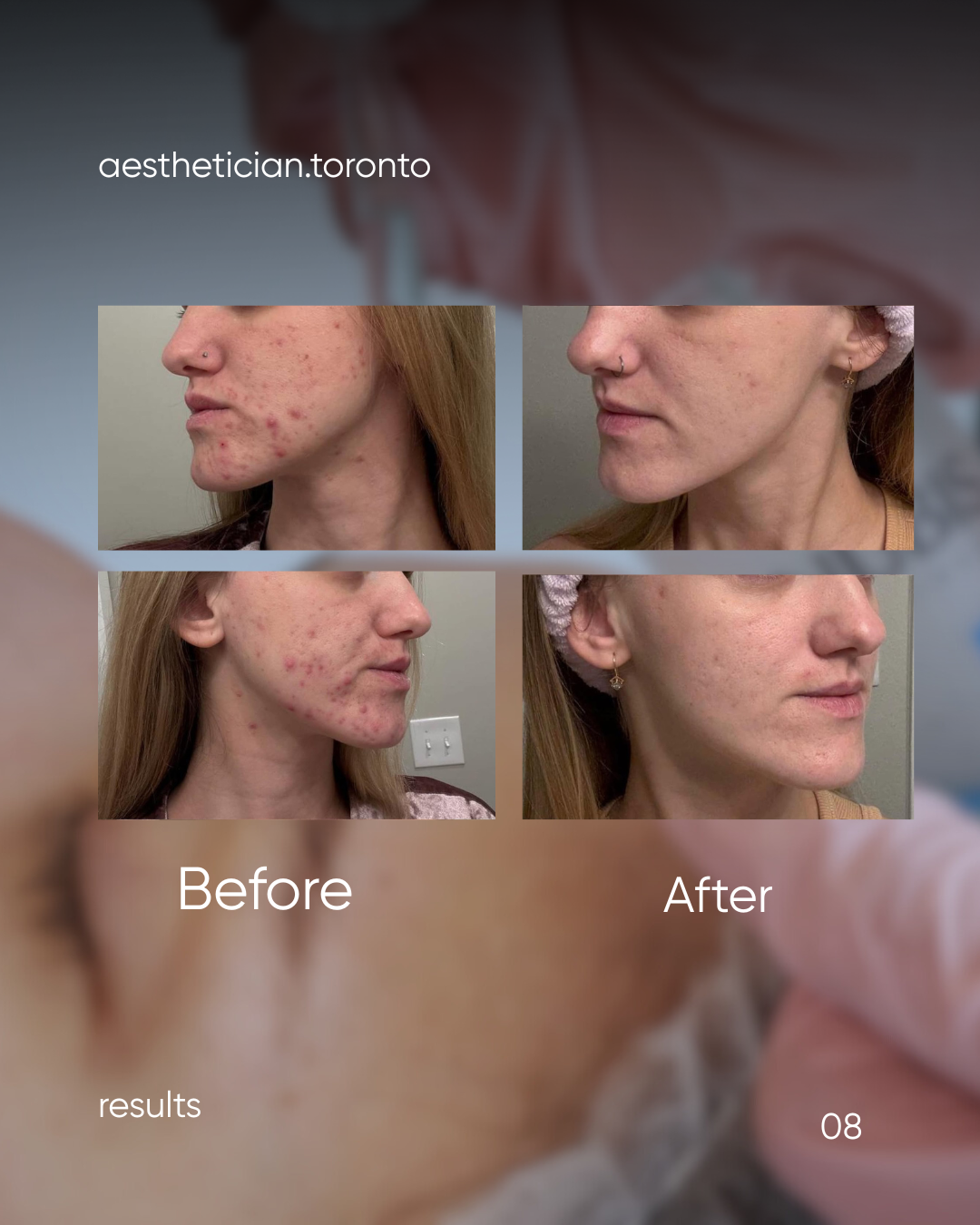 Side-by-side comparison of a woman's face before and after acne treatment. The before images show significant facial acne with redness and pimples. The after images display clearer skin with fewer blemishes and reduced redness.