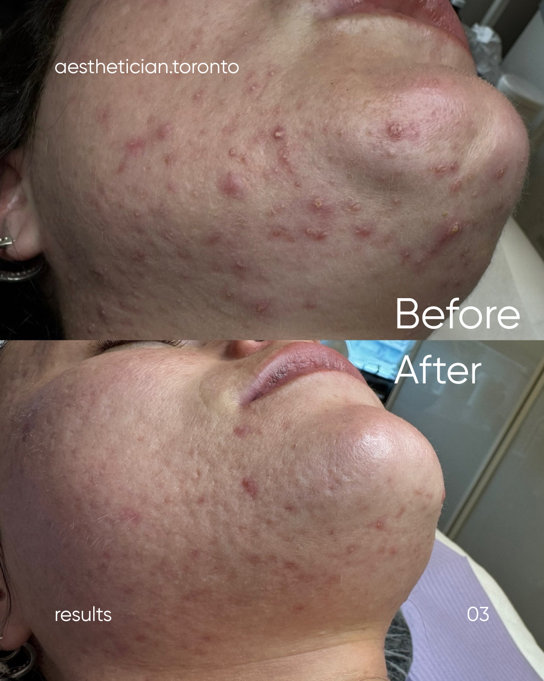 Comparison of a woman's chin and lower face before and after skincare treatment. The 'before' image shows numerous pimples and skin blemishes, while the 'after' image shows clearer, smoother skin with fewer blemishes.