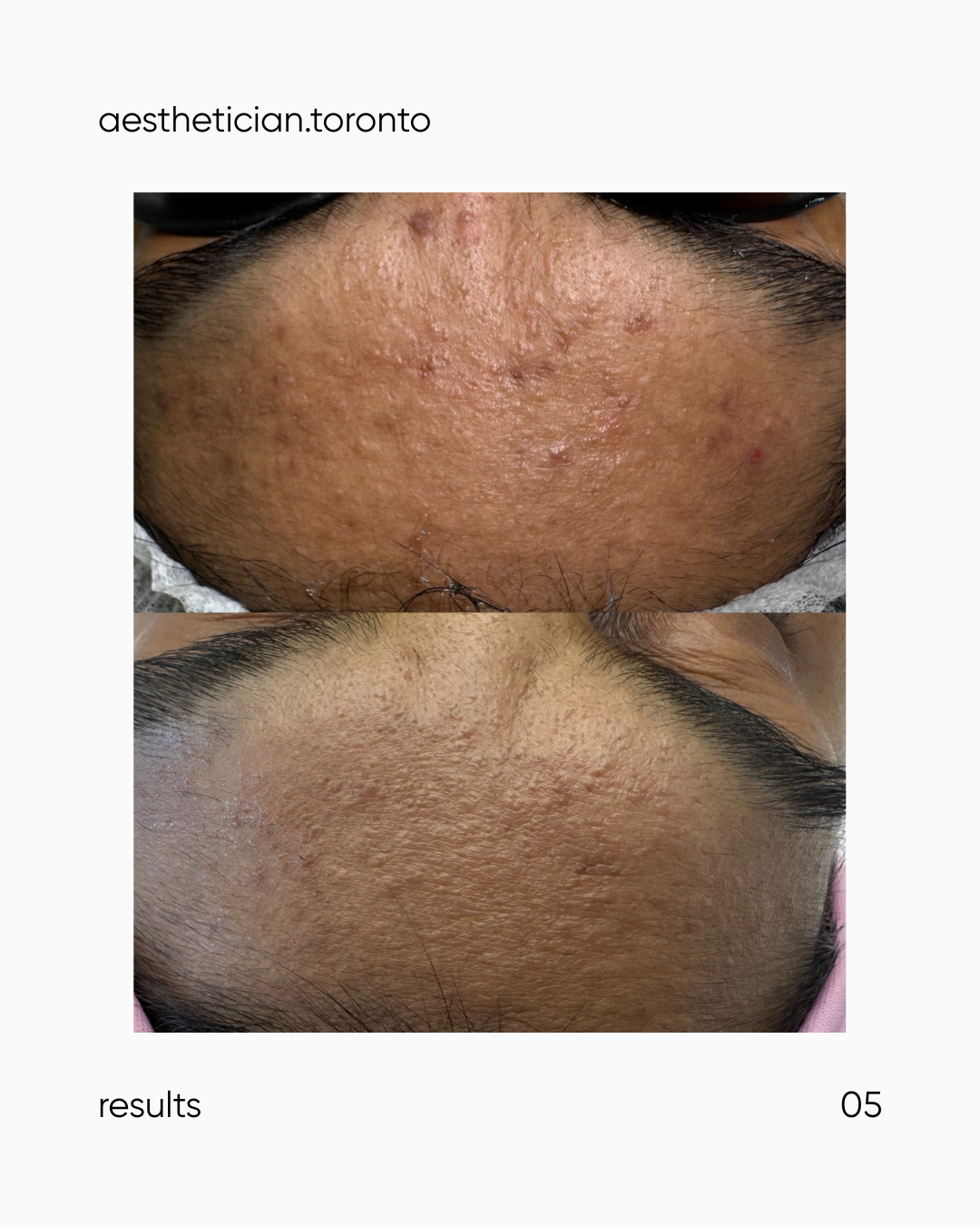 Close-up of a person's forehead showing before and after acne treatment results