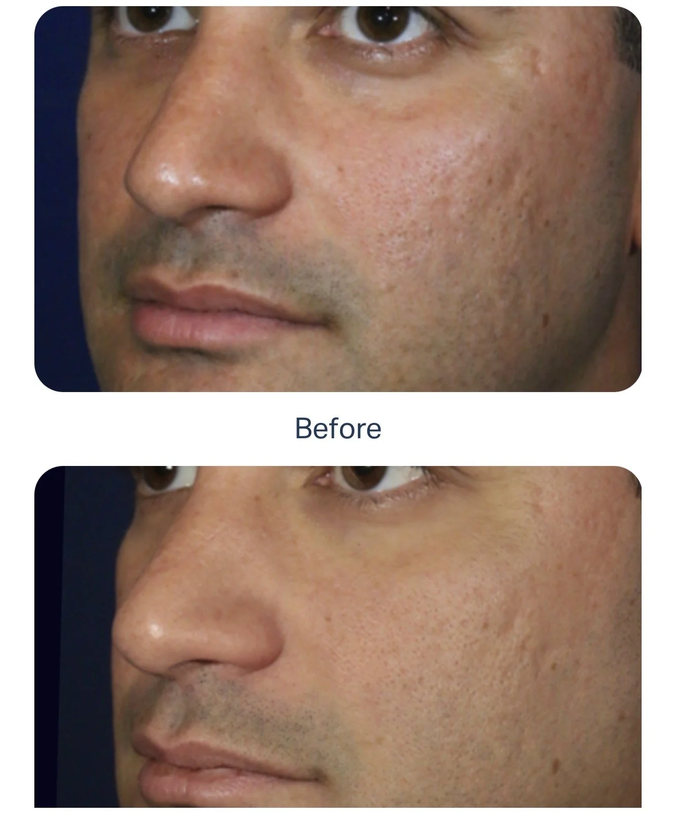 Close-up of a man's face showing before and after images of skincare or cosmetic treatment, highlighting improved skin texture and reduced redness.
