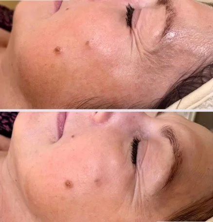 Before and after pictures of woman who received a Lysne dermaplaning treatment