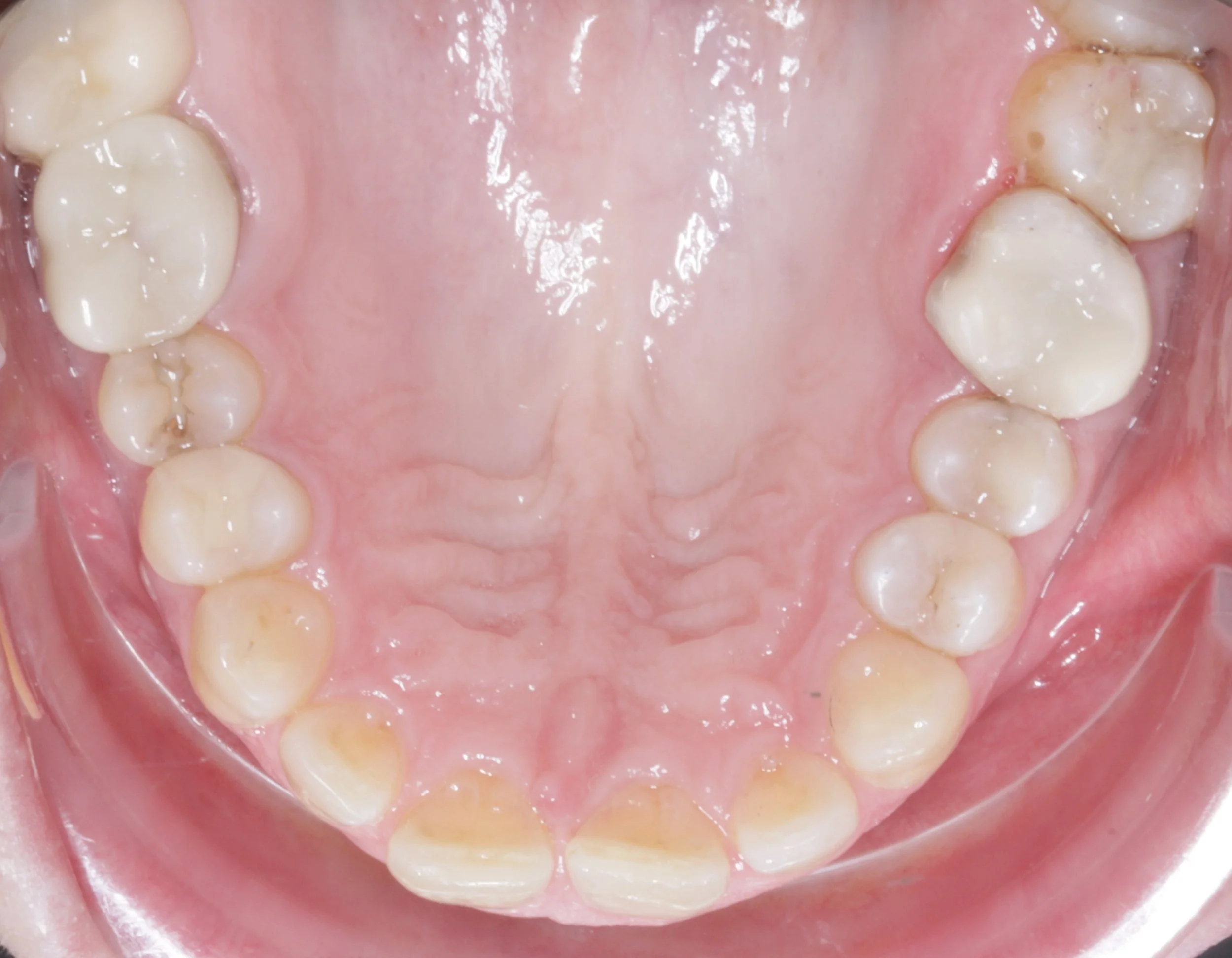 Improvement with new white restorations.jpg
