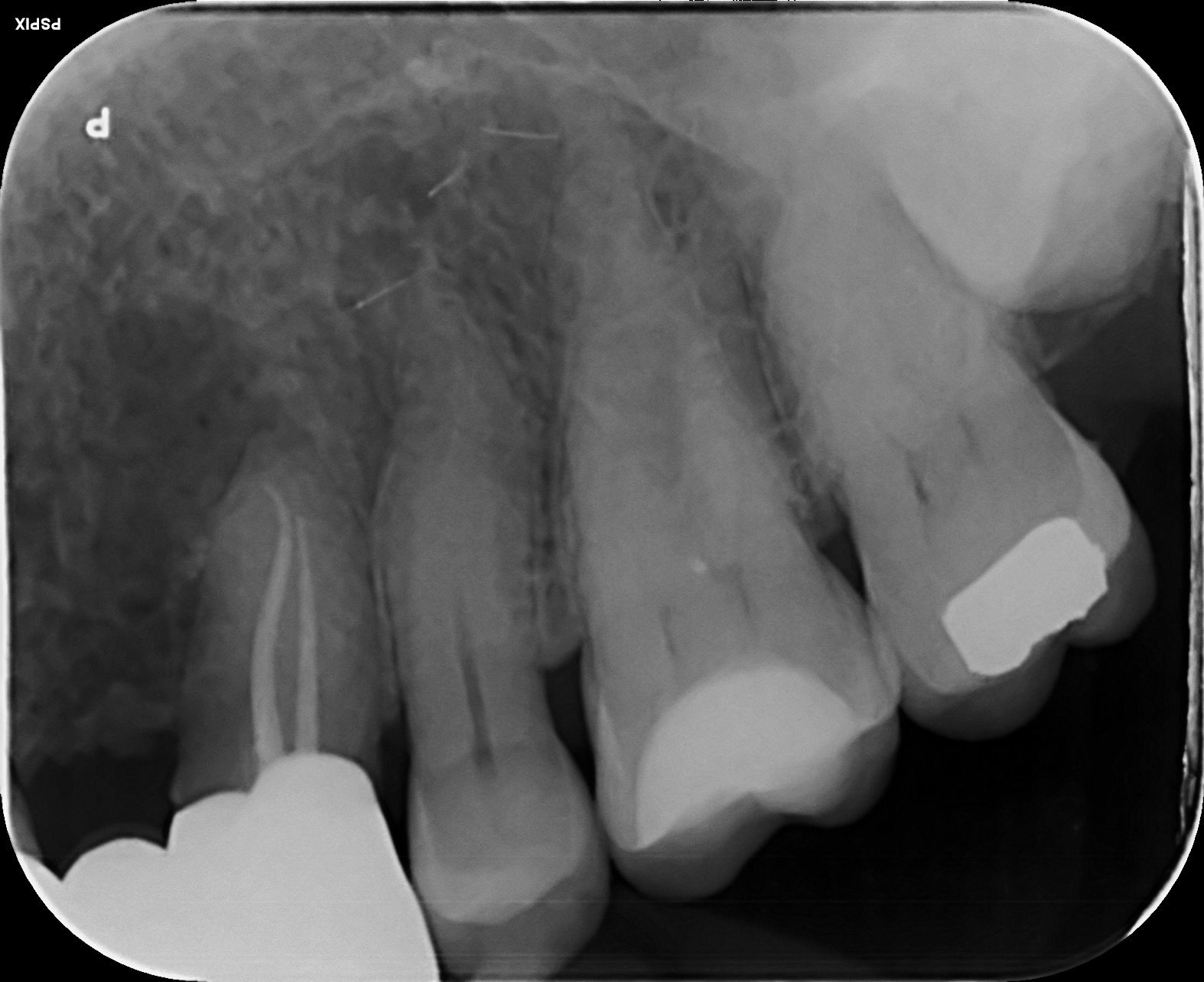 Root canal treated and bridge saved.jpg