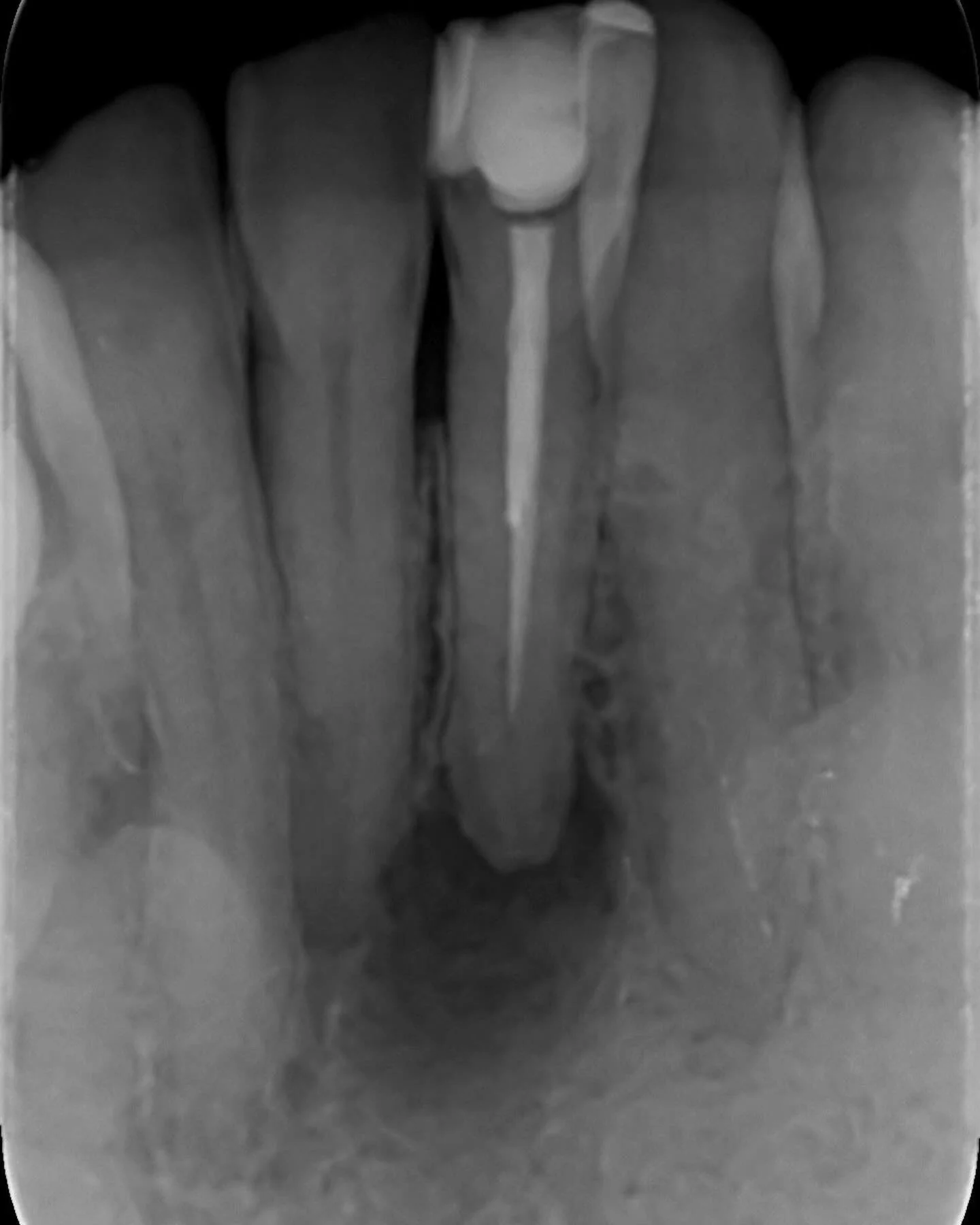 Failed old root canal causing tooth discolouration.JPG