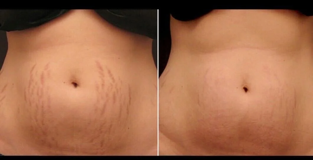STRETCHMARK REVISION