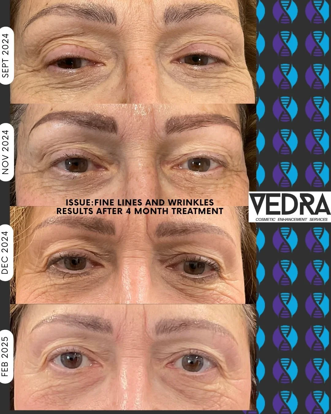 MICHROCHANNELING TREATMENT