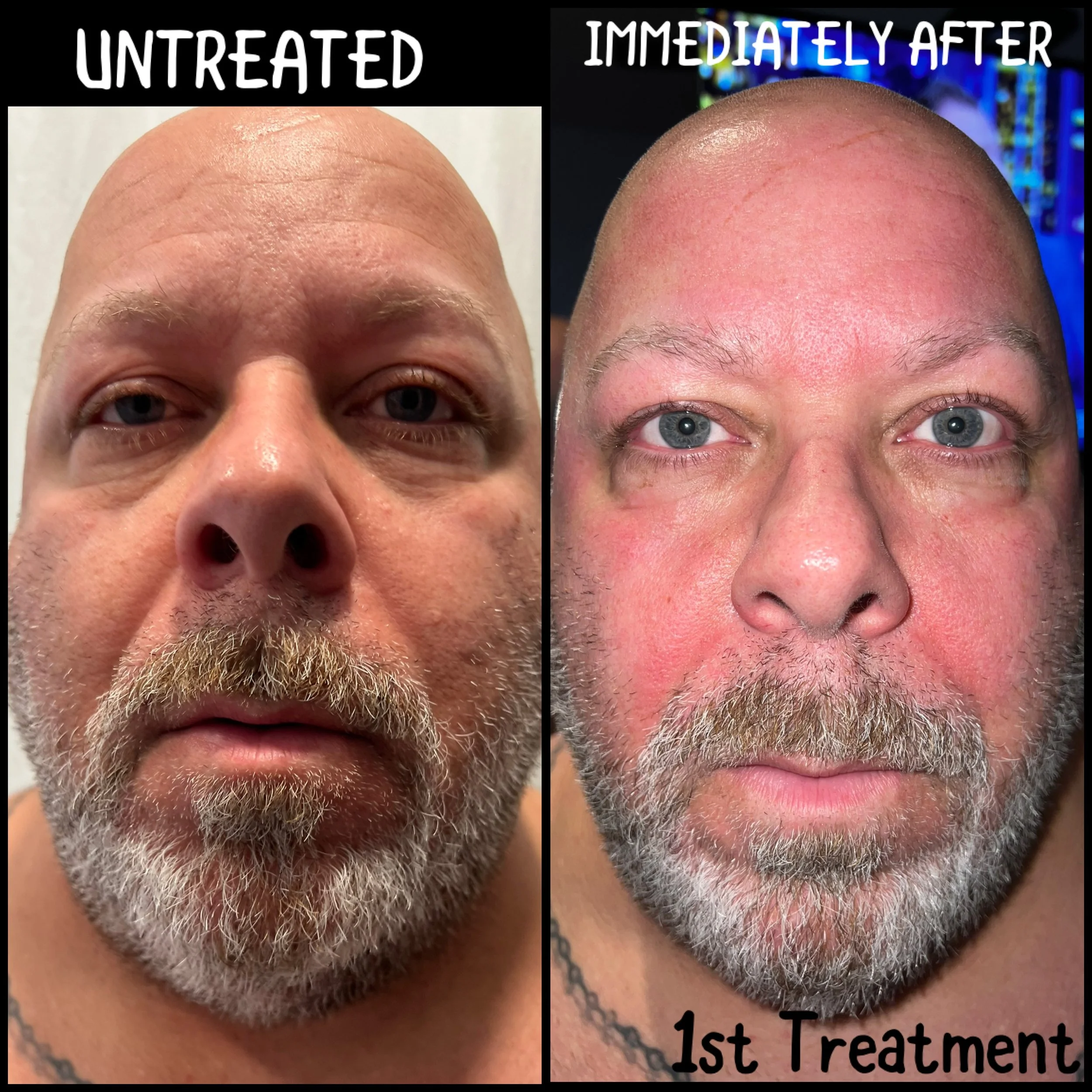 MICROCHANNELING TREATMENT
