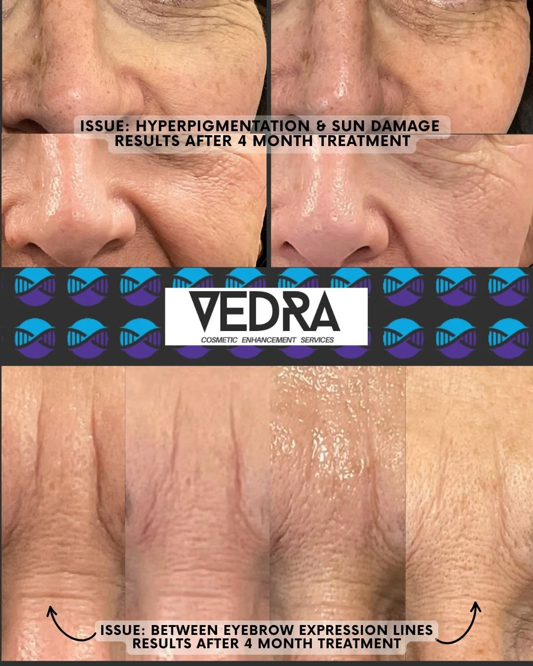 MICROCHANNELING TREATMENT