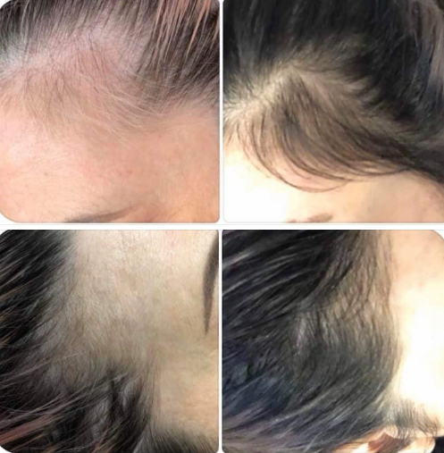 HAIR RESTORATION