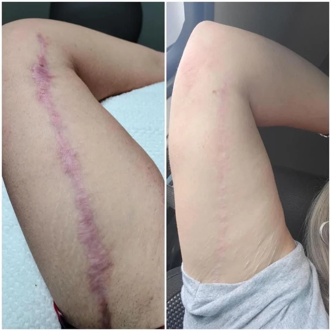 SCAR REVISION