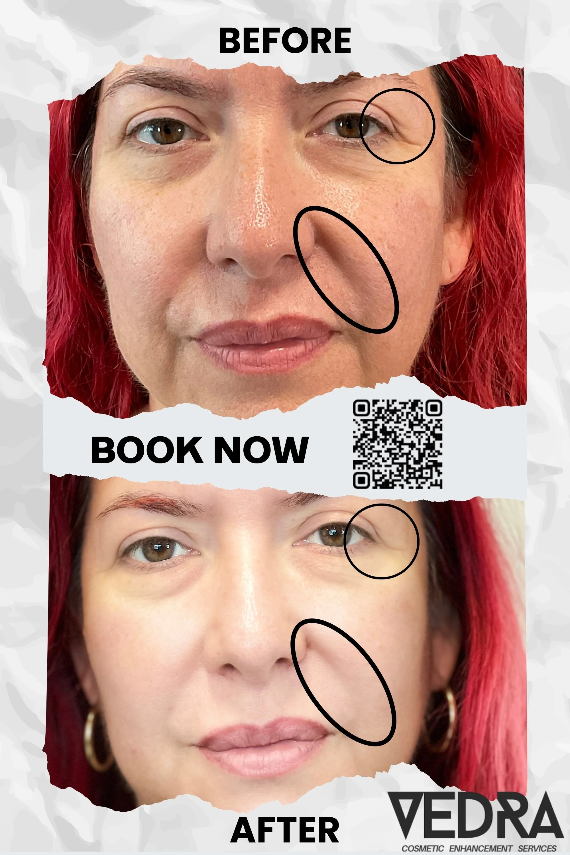 MICHROCHANNELING TREATMENT