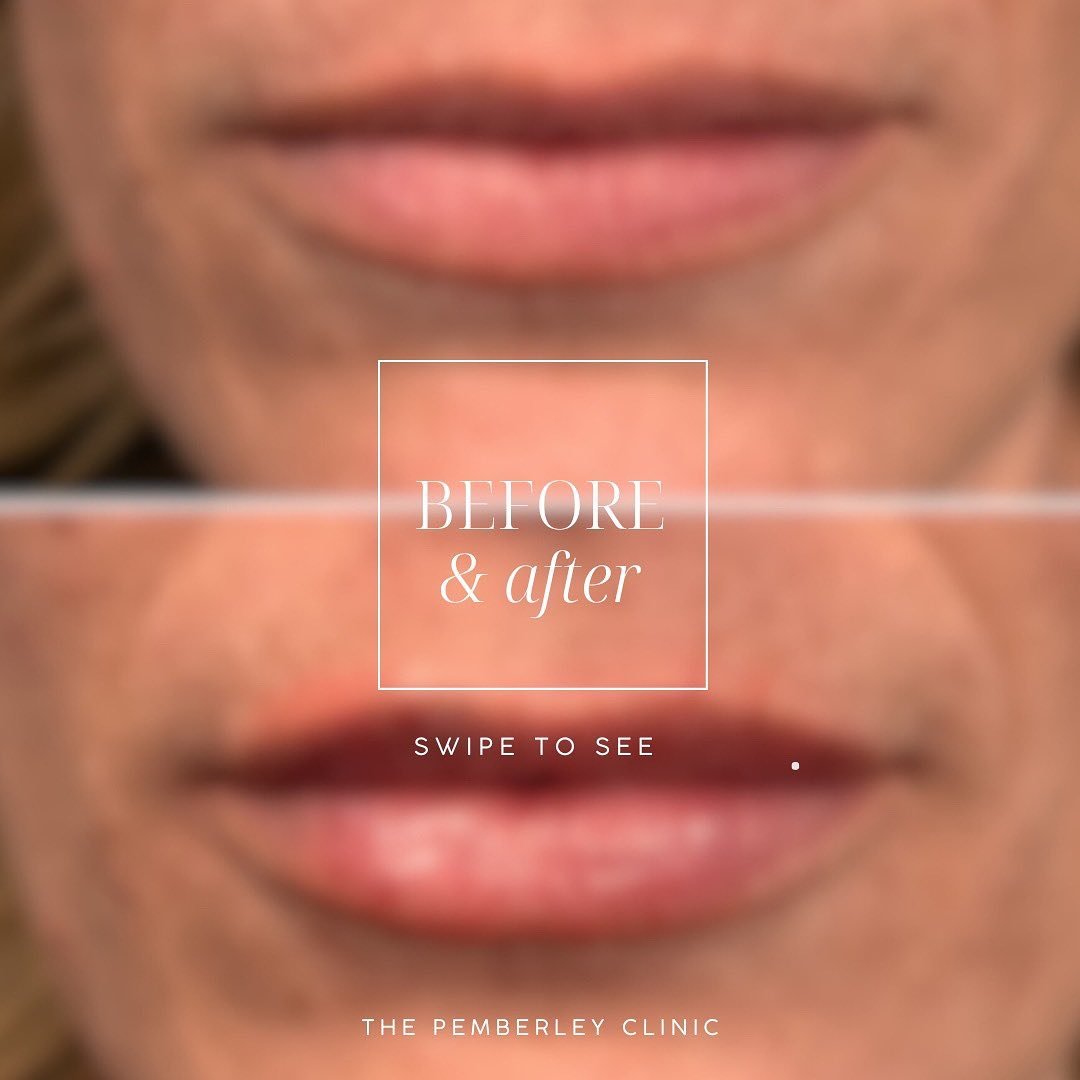 LETS TALK LIPS 👄 

It was a first for this patient and she was incredibly nervous. Her main concern was looking done. 
She definitely came to the right clinic!! 

Lip enhancement and hydrate are my more popular treatments that give my patients huge 