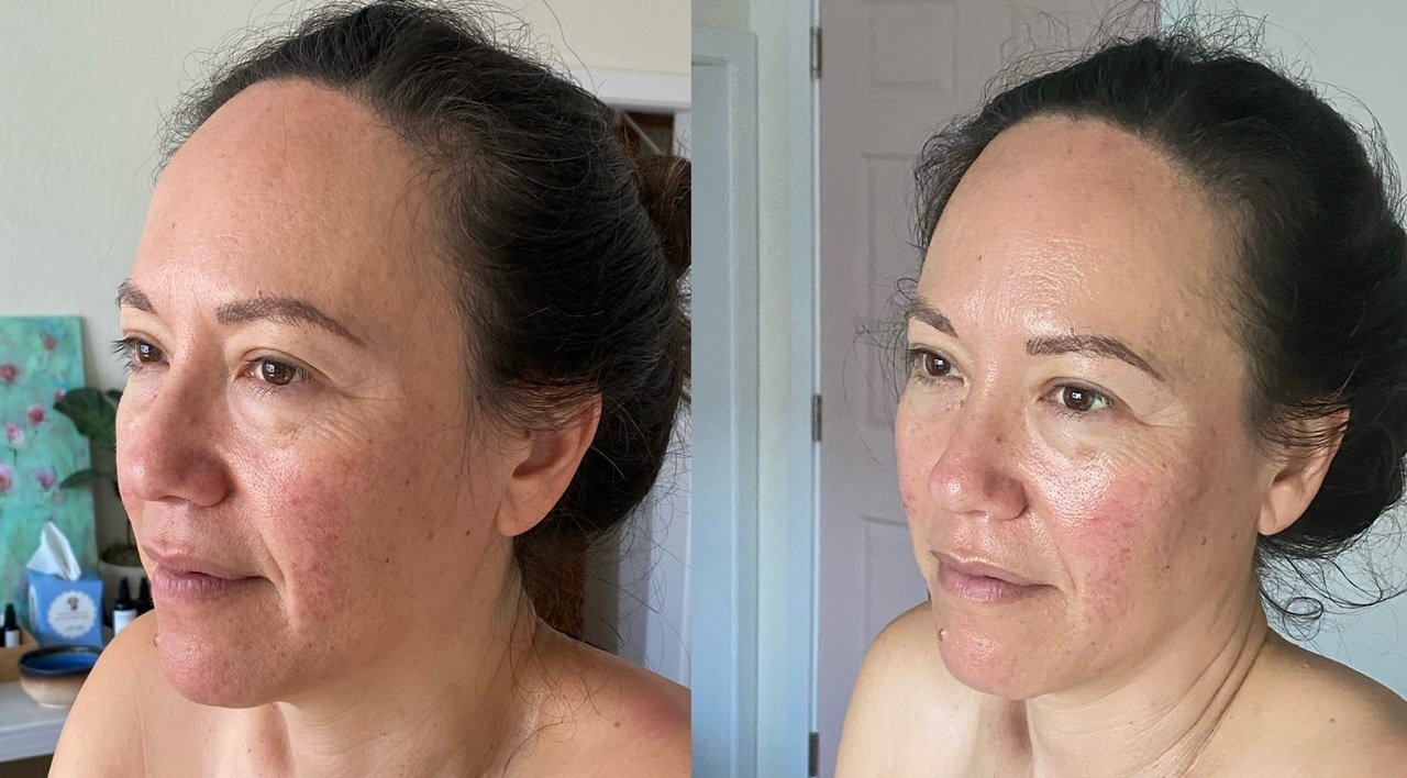 Before and After an AcuGlow treatment (no needles)