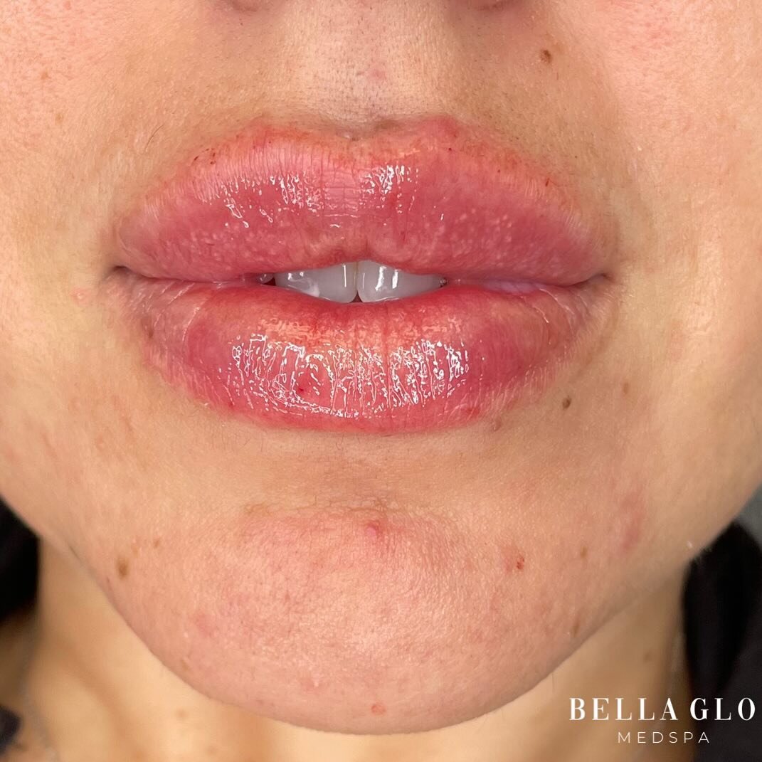 Lip filler: the secret to an instant confidence boost.💋

______________________________

CONTACT
📧Hello@bellagloaesthetics.com
🌐www.BellaGloAesthetics.com
☎️+17604537523
📍2808 Roosevelt St Suite 101, Carlsbad, CA 92008

#bellaglomedspa #bellaglob