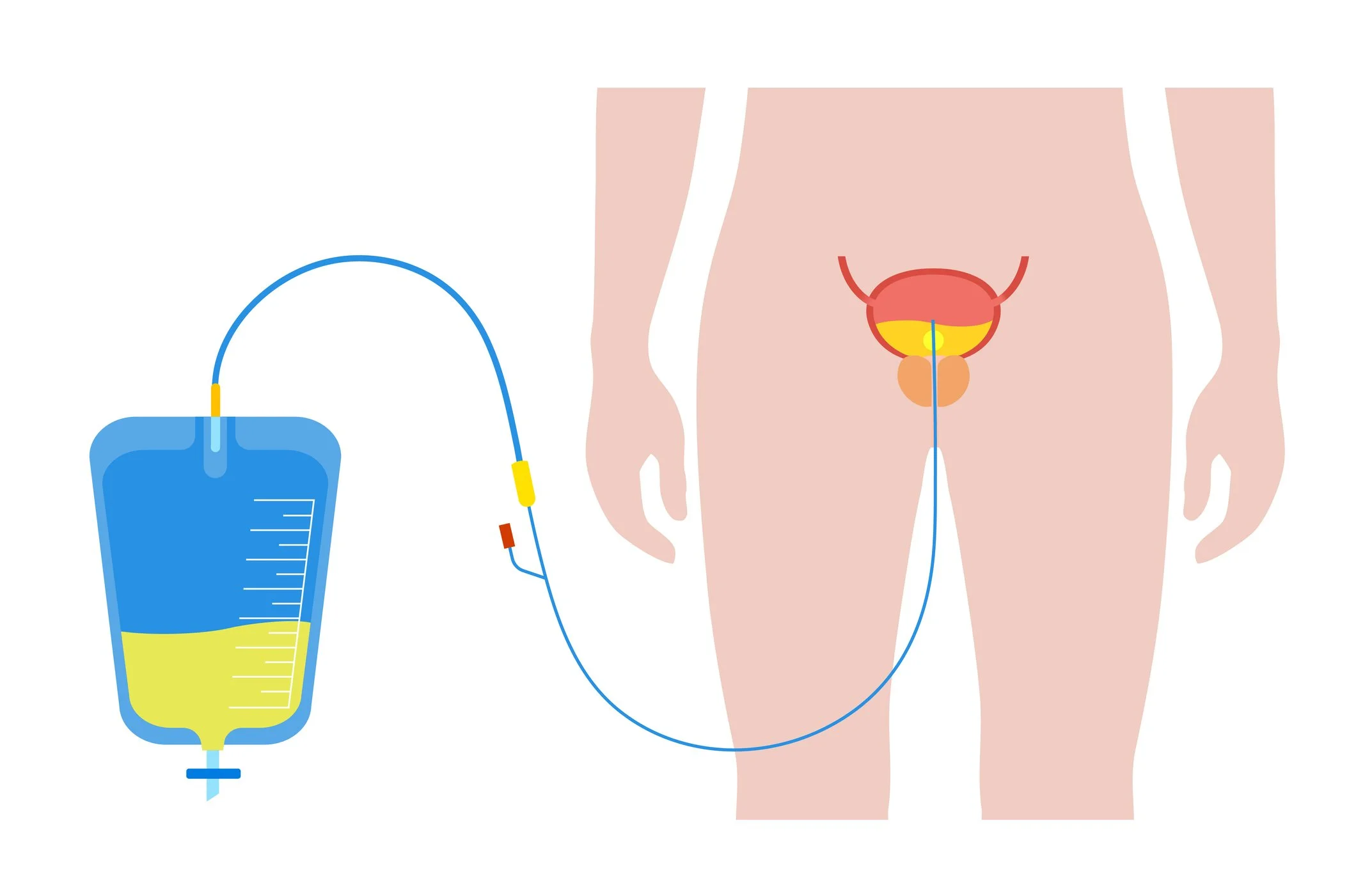 Living With a Urinary Catheter in Australia: Expert Advice from Melbourne Urologist Dr Deanne Soares