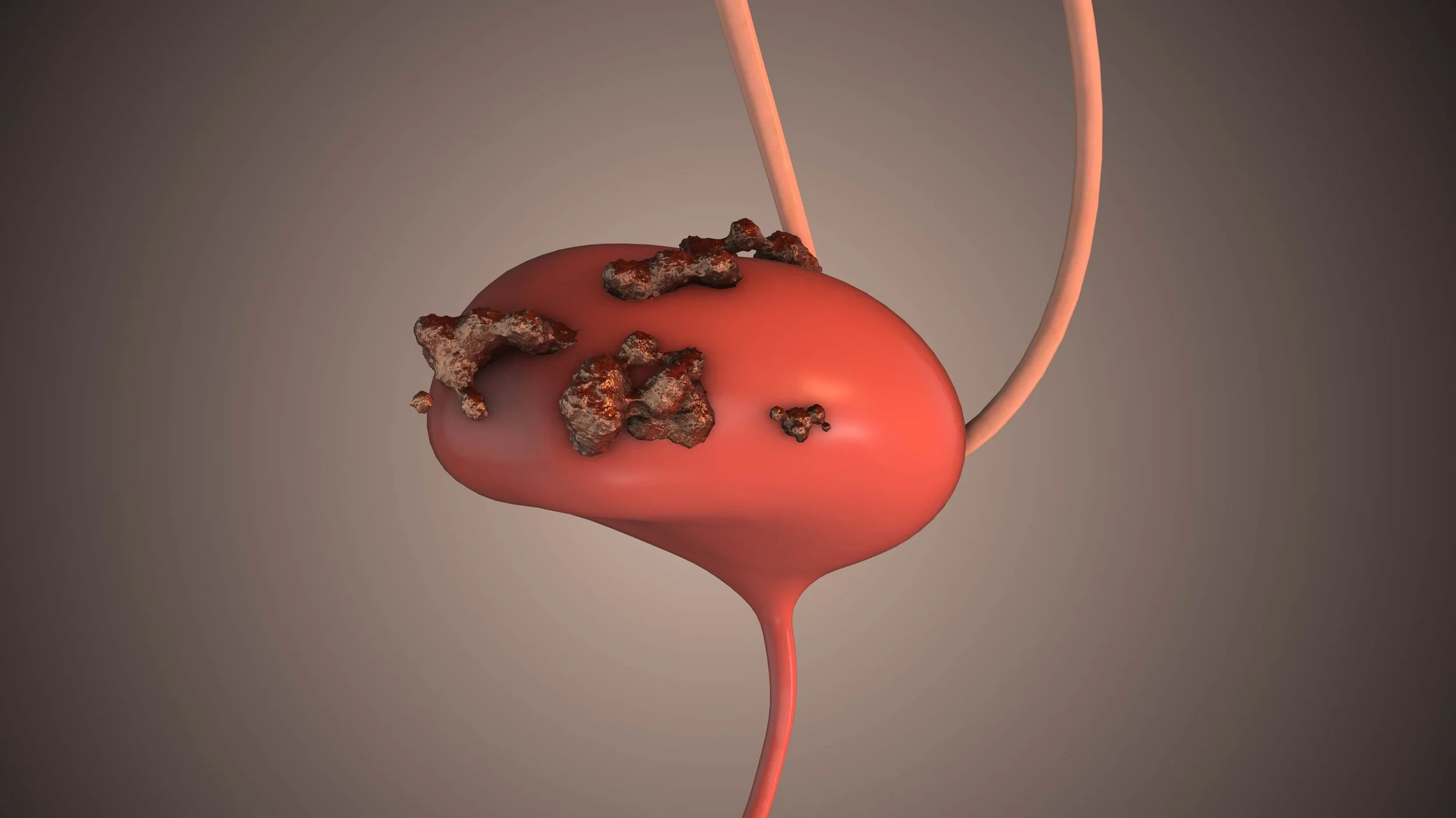 Bladder Cancer Surgery: An Overview of Modern Surgical Management