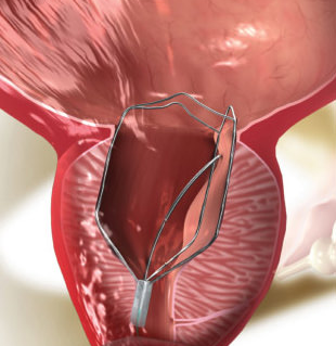 iTind for Enlarged Prostate (BPH): What to Expect, Who It Suits, and How It Compares