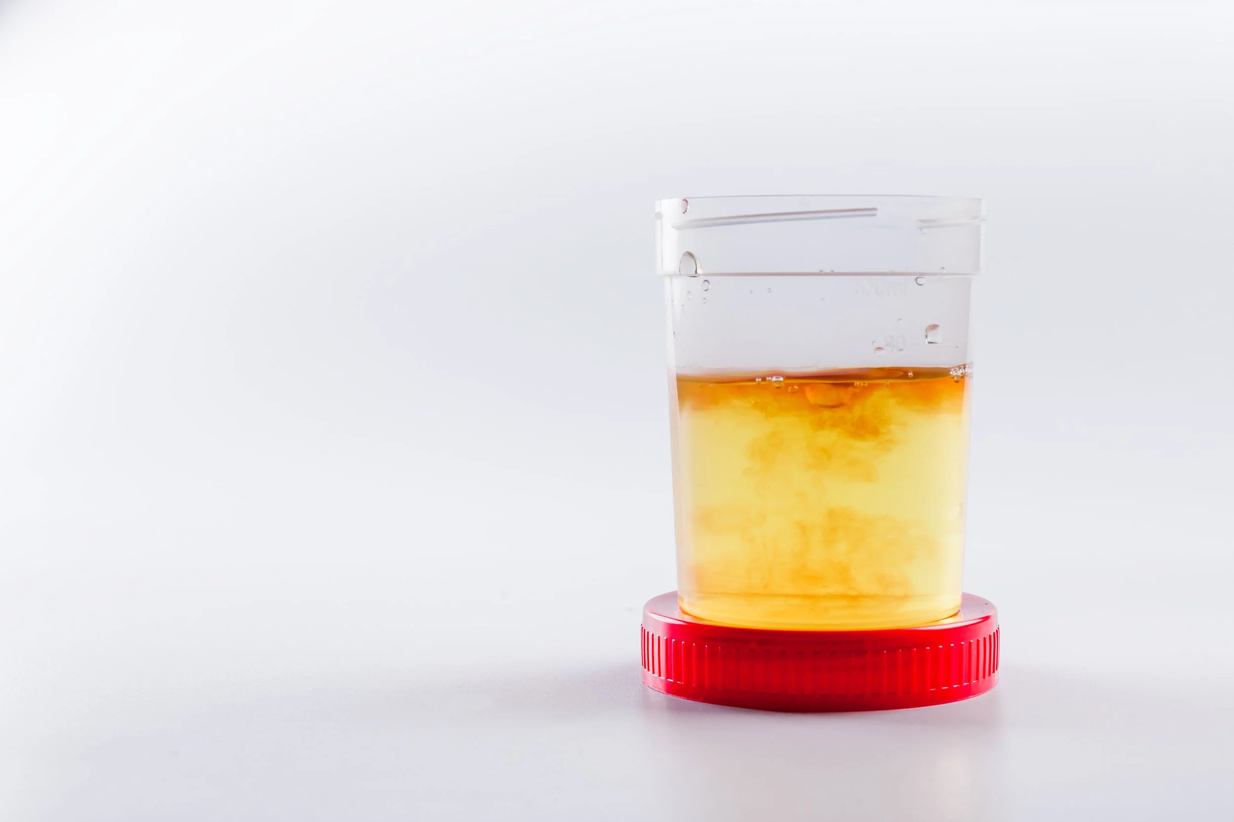Blood in Urine: When Is It Cancer and What Happens Next?