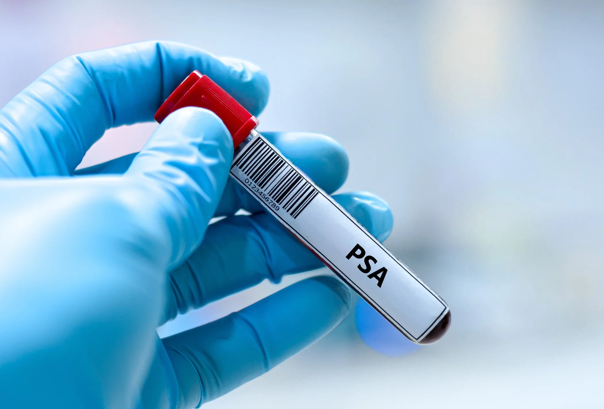 PSA After Prostatectomy: What Your Number Means and When It Matters