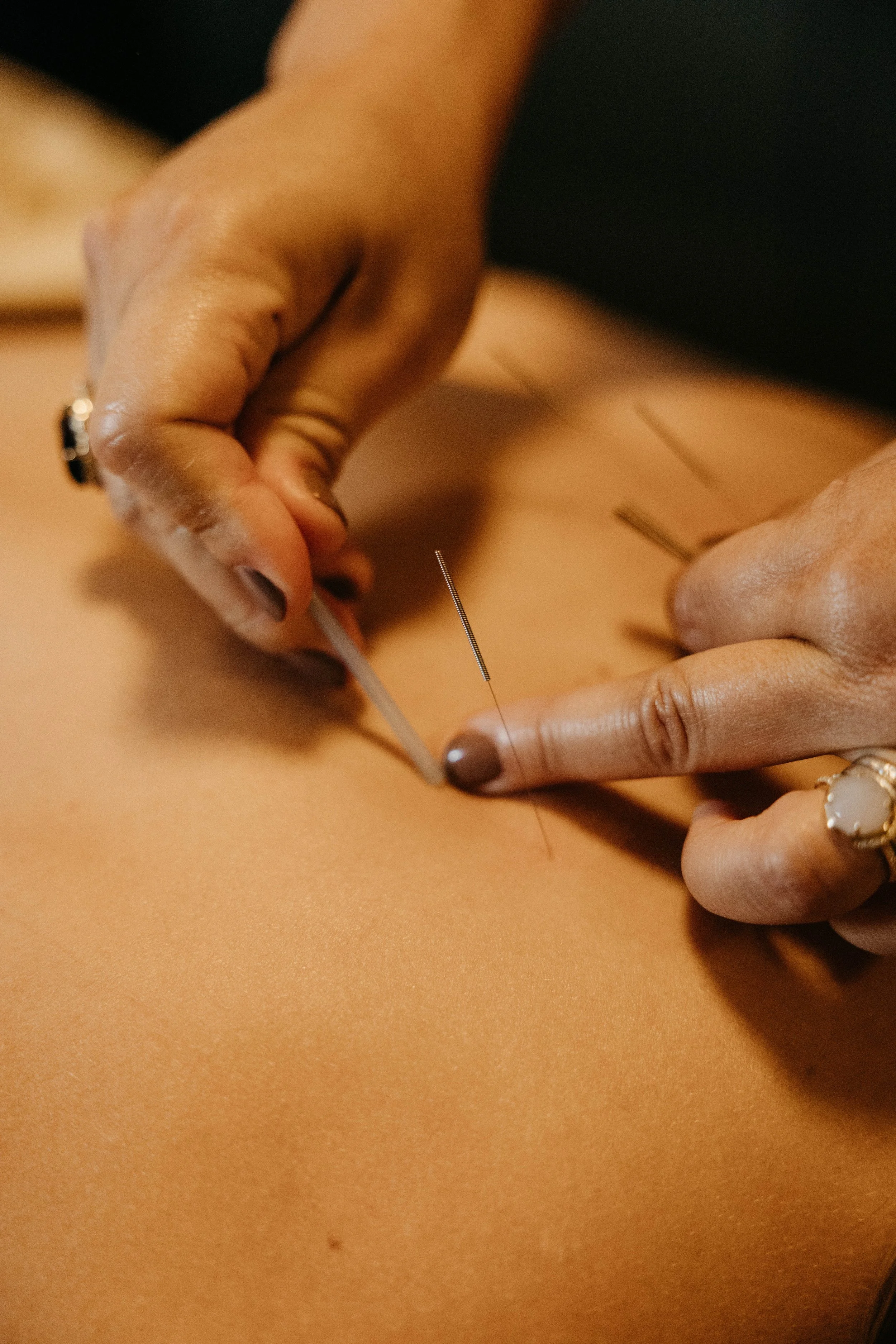 Free Community Acupuncture