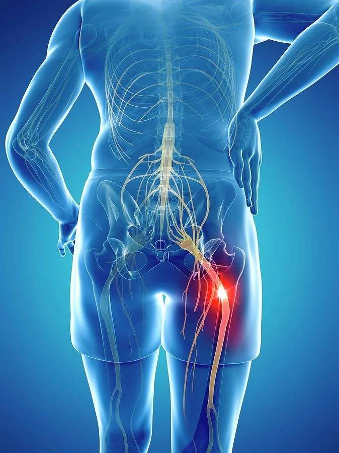 Illustration of the spine and nerves, showing the source of back pain and sciatica