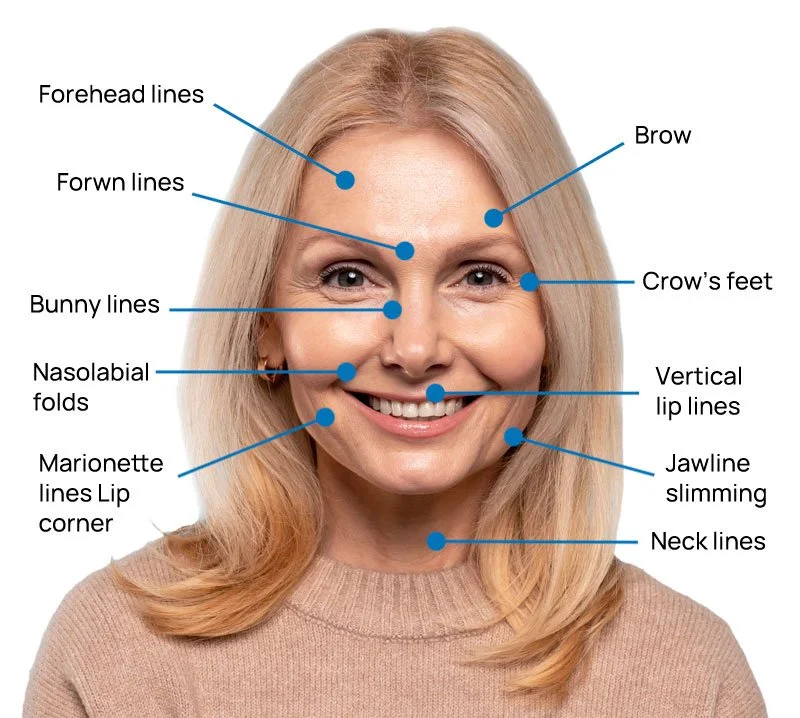 Common Botox treatment areas on the face at Panda Revival Lab in Surrey
