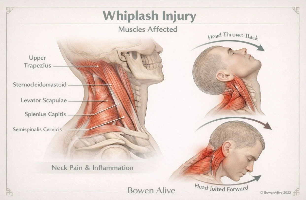 Whiplash Treatment | Concussion Treatment | Ipswich QLD