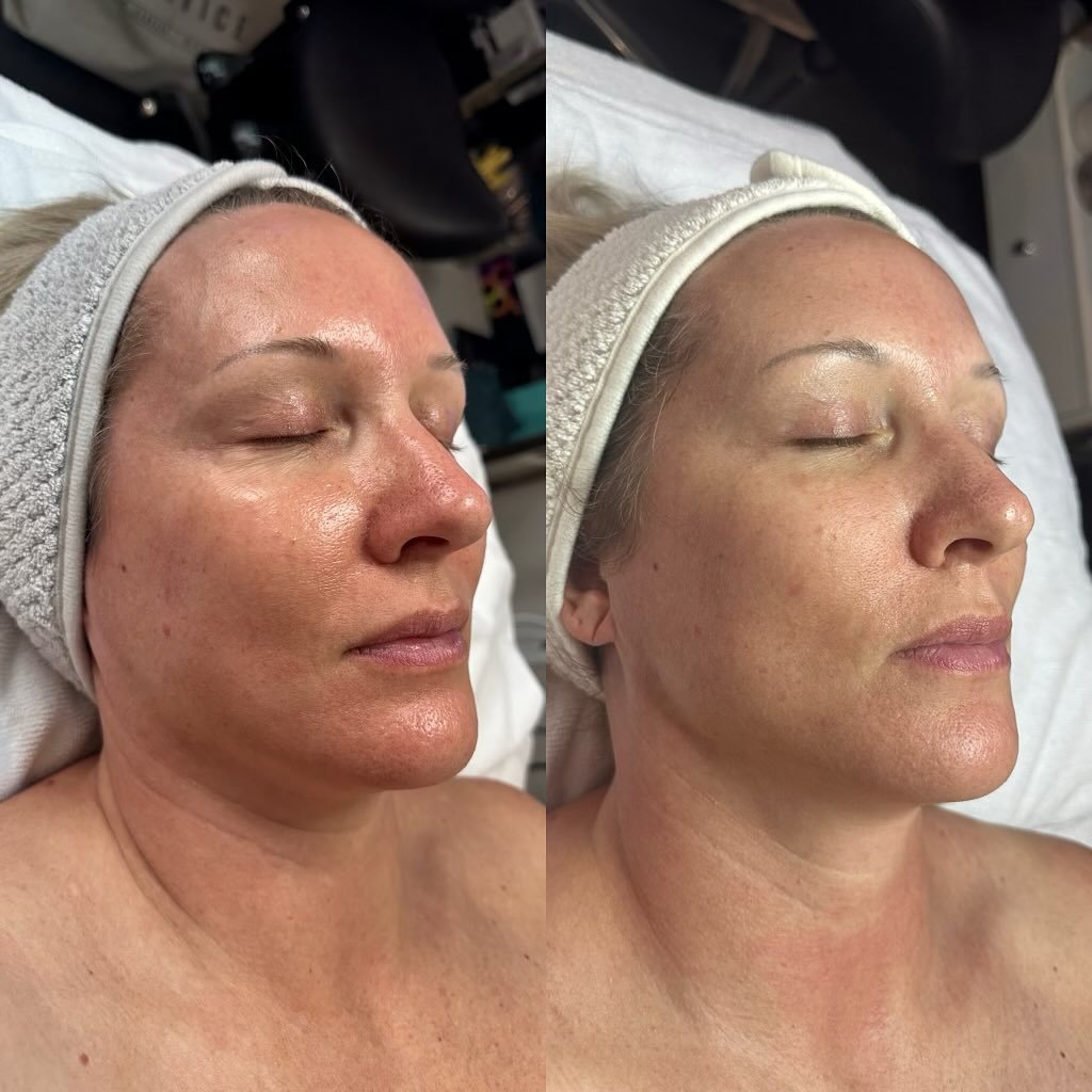 skin pen + micro needling results after just one treatment ✨
looking for smoother, more radiant, younger looking skin?
skin pen is for you! 

*SkinPen is clinically proven to fight the appearance of neck wrinkles and reduce the appearance of acne sca