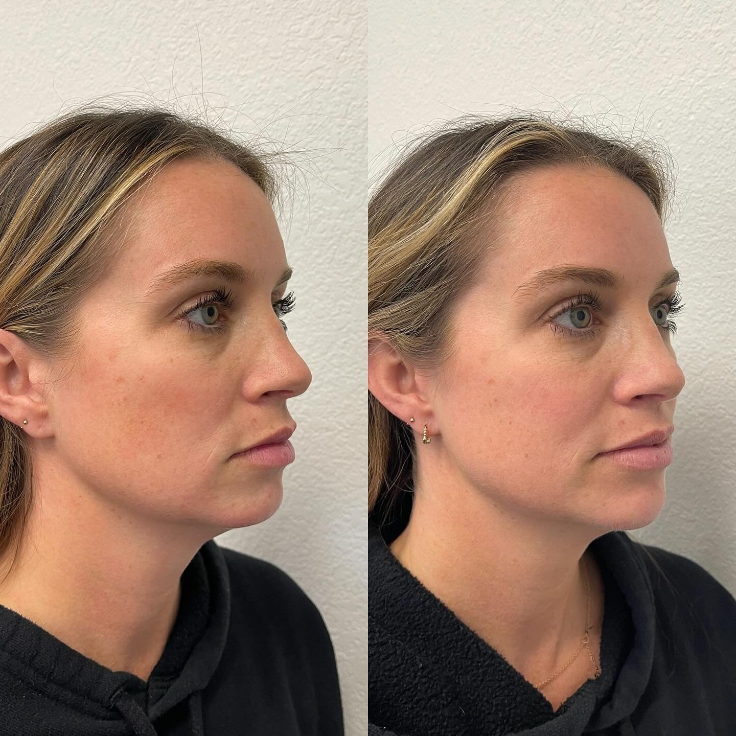 new chin, who this? 

Robyn, @holistic.beauty.nurse is very conservative with her patients, so we just started slow with 1 syringe to build chin length &amp; projection while also blending well. She also did Dysport under her chin to retract the neck