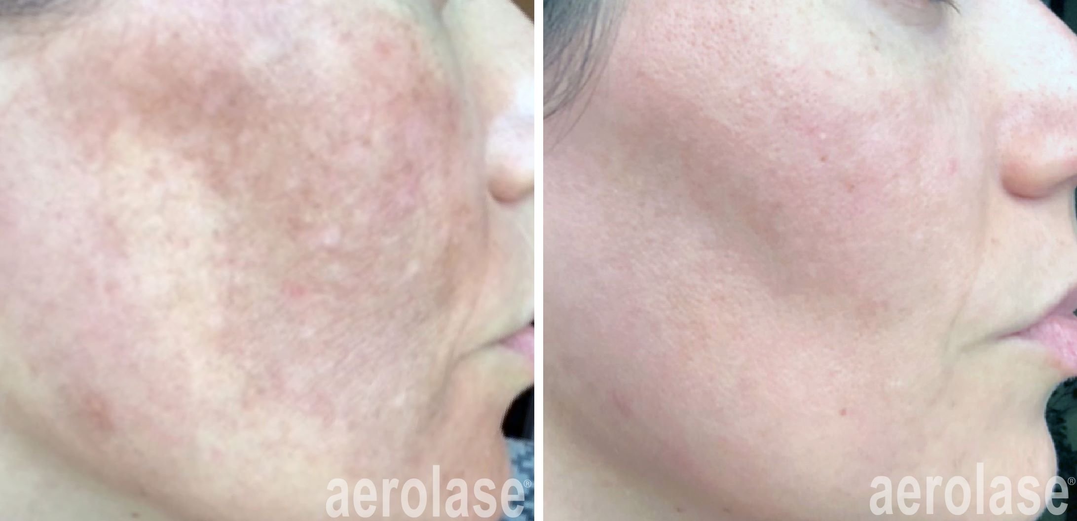 Aerolase before and after treatment for melasma