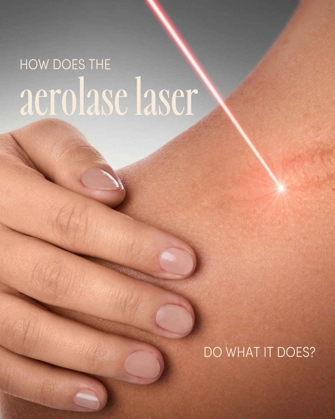 Aerolase is a state-of-the-art aesthetic laser used for gentle skin tightening and rejuvenation. It effectively treats over 30 skin conditions, including acne, age spots, and fine lines and wrinkles. Aerolase laser light is attracted to melanin, hemo