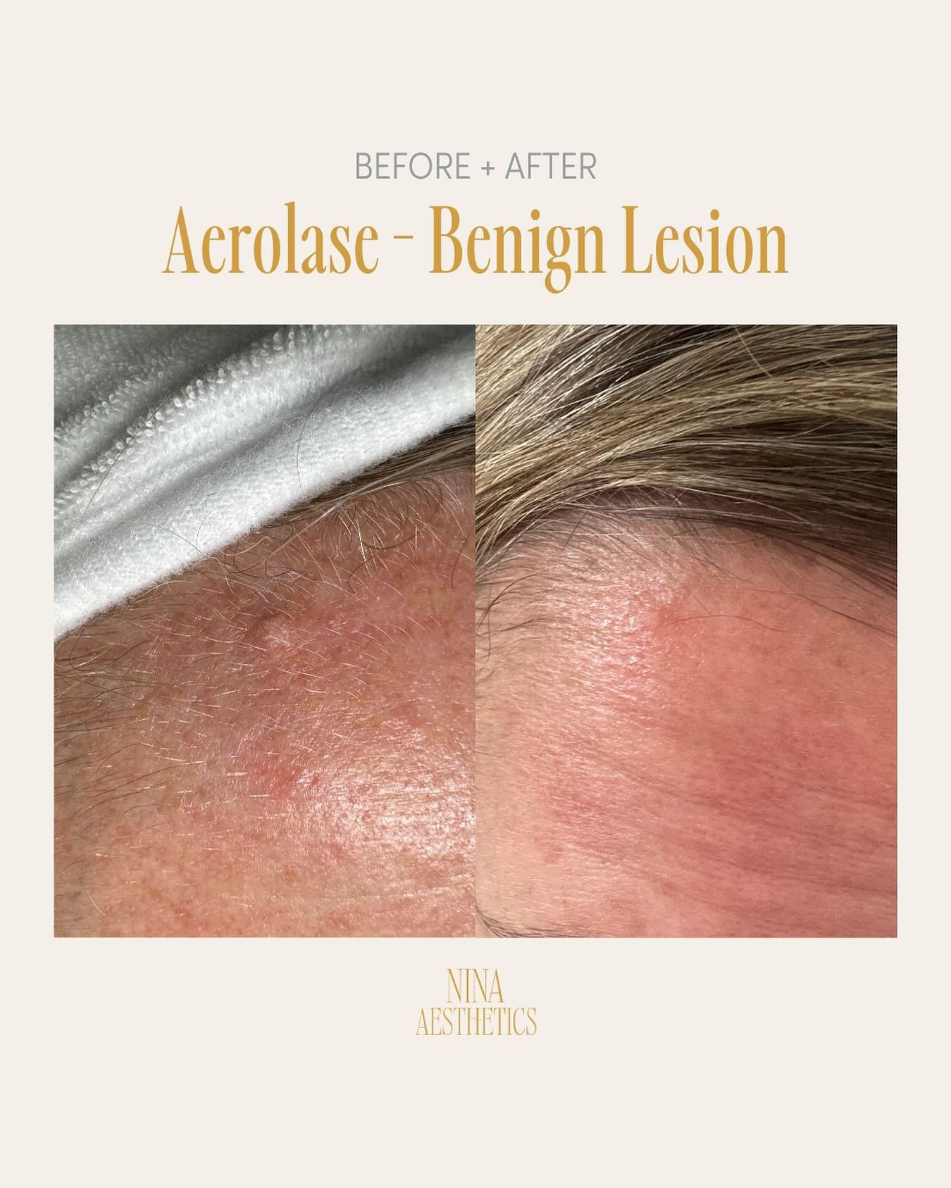 What can&rsquo;t #aerolase do?

Here we used the Aerolase laser to treat a benign lesion and you can really see the difference! If you have any, and I mean ANY skin condition you&rsquo;d like resolved, shoot us a message and ask us about Aerolase. Wh