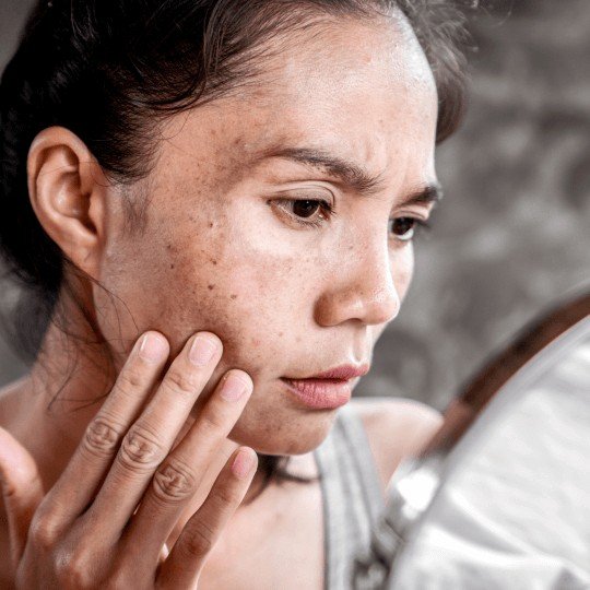 Treating Hyperpigmentation: Combination Therapy for a Bright and Even Complexion