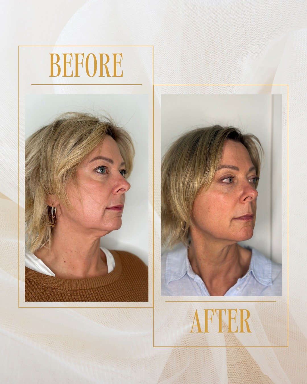 Subtle lift. Serious results.
This HIFU transformation by Dearne Gilbert shows just how powerful non-invasive skin tightening can be.