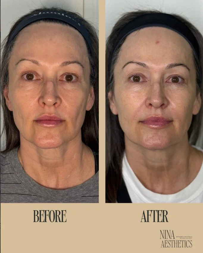 Sculptra Cheek Injections: The Secret to Lifting and Brightening Your Entire Midface